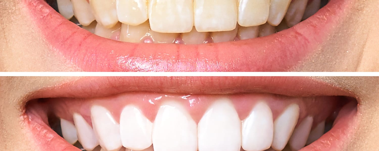 Tooth Bleaching Normal IL